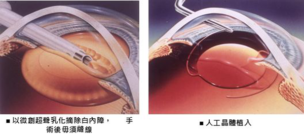 白內(nèi)障