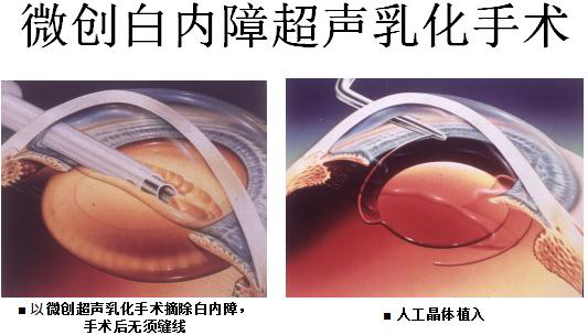 白內障