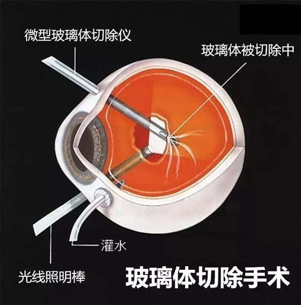 玻璃體視網膜