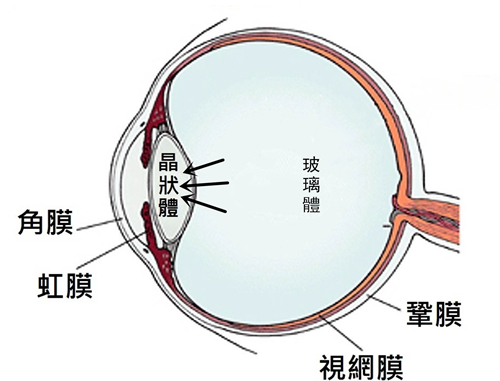 白內障