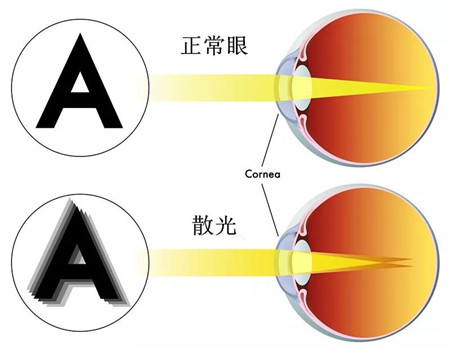 屈光矯視
