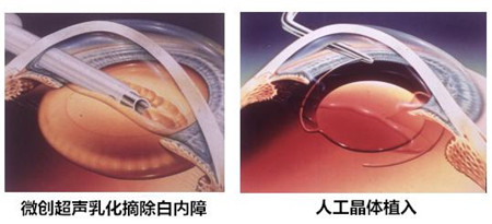 白內障