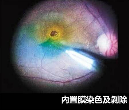 玻璃體視網(wǎng)膜