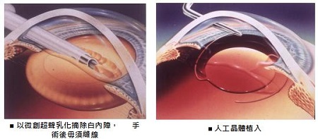 白內障