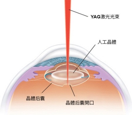 白內障
