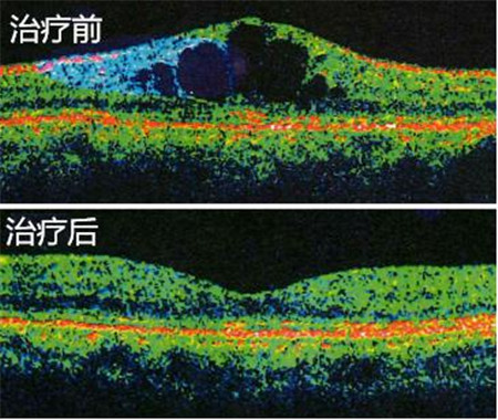 玻璃體視網(wǎng)膜