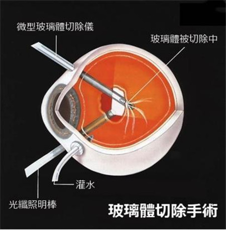 玻璃體視網膜