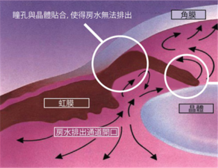 青光眼