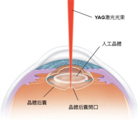 白內(nèi)障