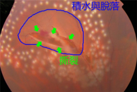 玻璃體視網(wǎng)膜