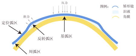 屈光矯視
