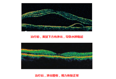 玻璃體視網膜