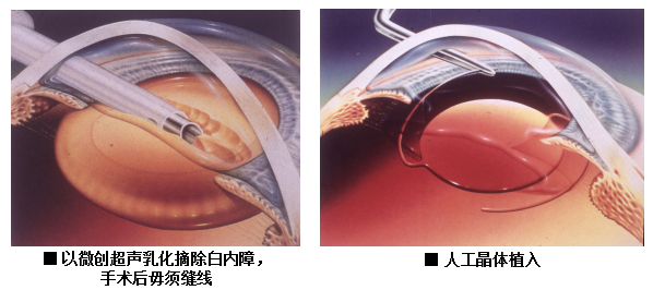 白內(nèi)障