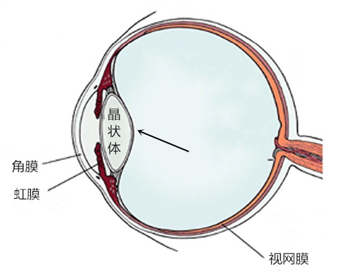 白內障