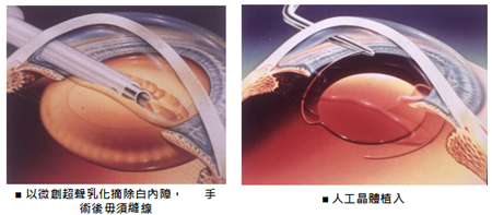 白內障