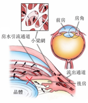 白內(nèi)障