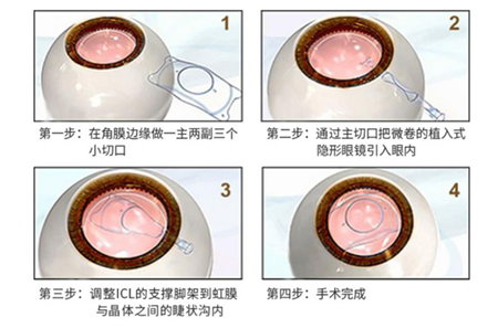 屈光矯視