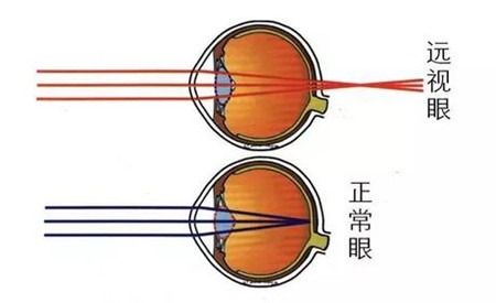 屈光矯視