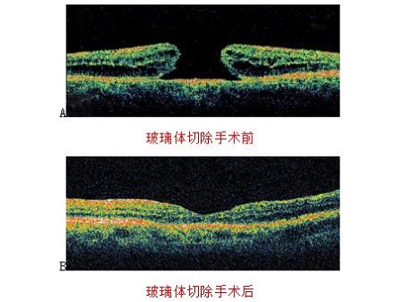 玻璃體視網(wǎng)膜