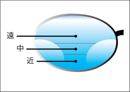 屈光矯視