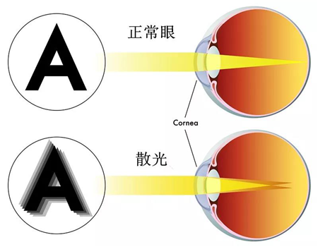 屈光矯視