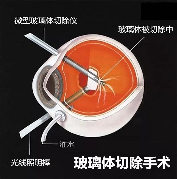 玻璃體視網膜