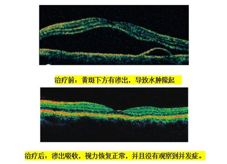 玻璃體視網膜