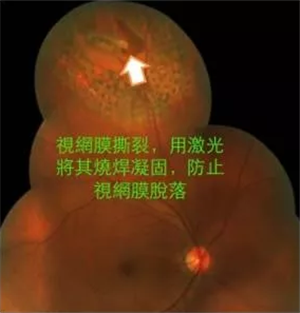 玻璃體視網膜