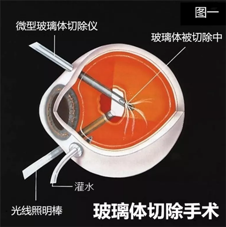 玻璃體視網(wǎng)膜