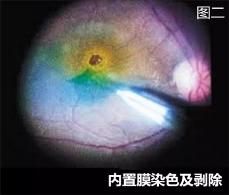 玻璃體視網(wǎng)膜