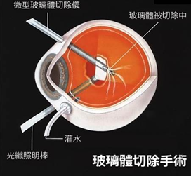 玻璃體視網膜