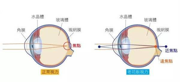 屈光矯視
