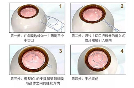 屈光矯視