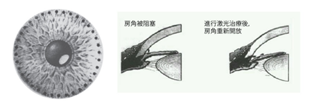 白內障