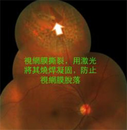 玻璃體視網膜