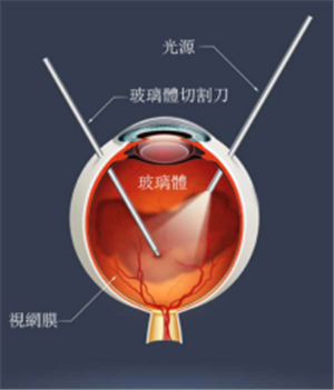 玻璃體視網(wǎng)膜
