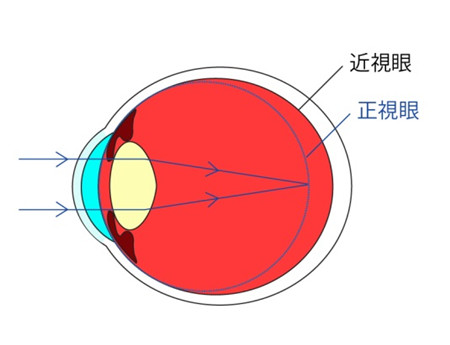 屈光矯視