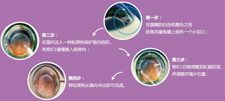 屈光矯視