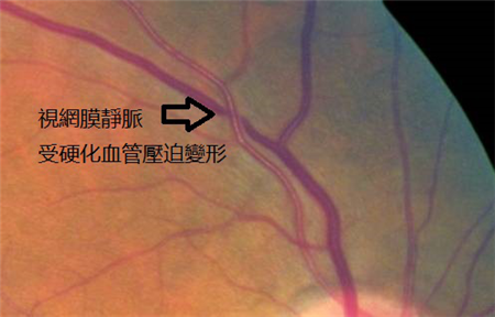 玻璃體視網(wǎng)膜