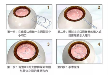 屈光矯視