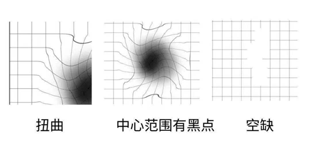 玻璃體視網膜
