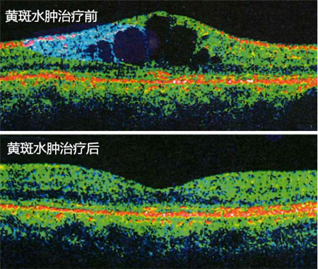 玻璃體視網(wǎng)膜