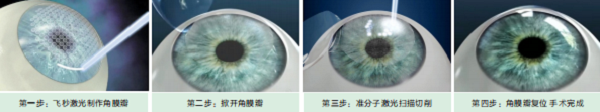 屈光矯視