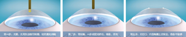 屈光矯視