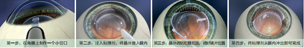 屈光矯視
