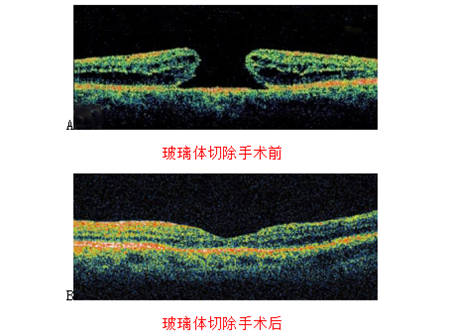 玻璃體視網(wǎng)膜