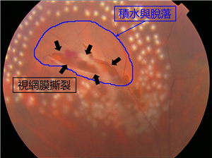 玻璃體視網膜