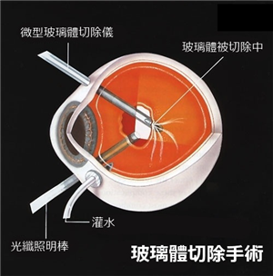 玻璃體視網膜