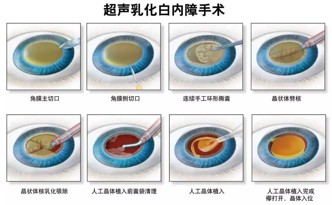 白內障