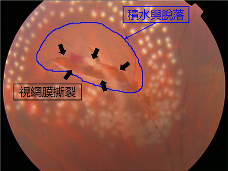 玻璃體視網(wǎng)膜